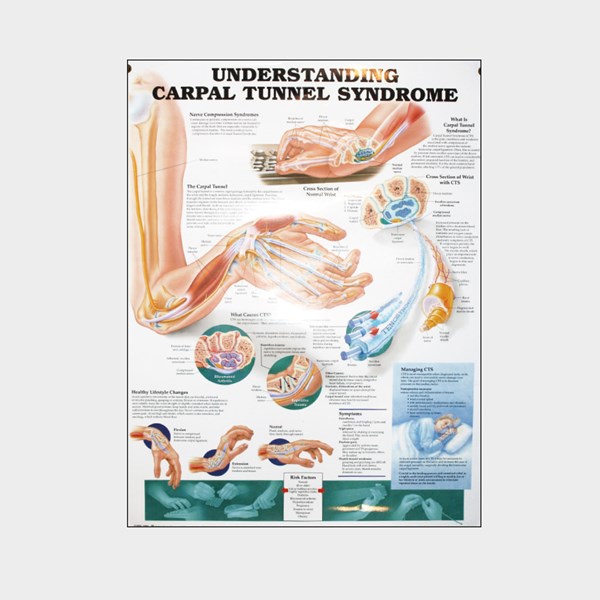 Wall chart - Carpal Tunnel Syndrome